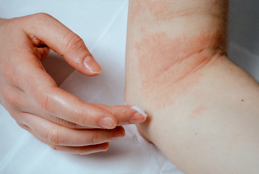 Eczéma: trouver les causes et le soigner naturellement